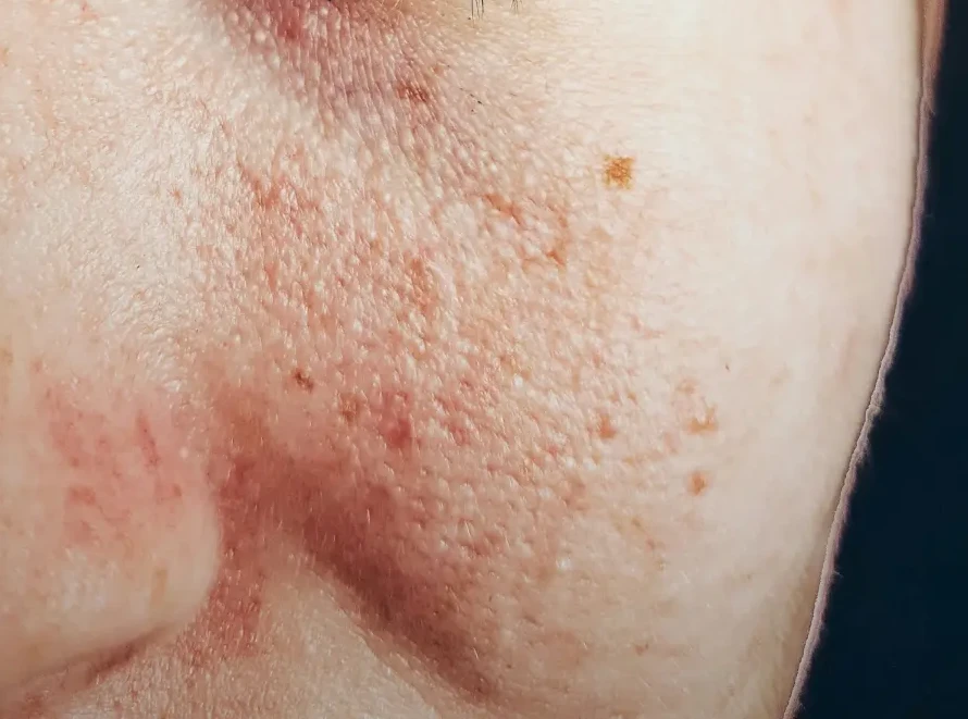 El agua micelar me irrita la piel